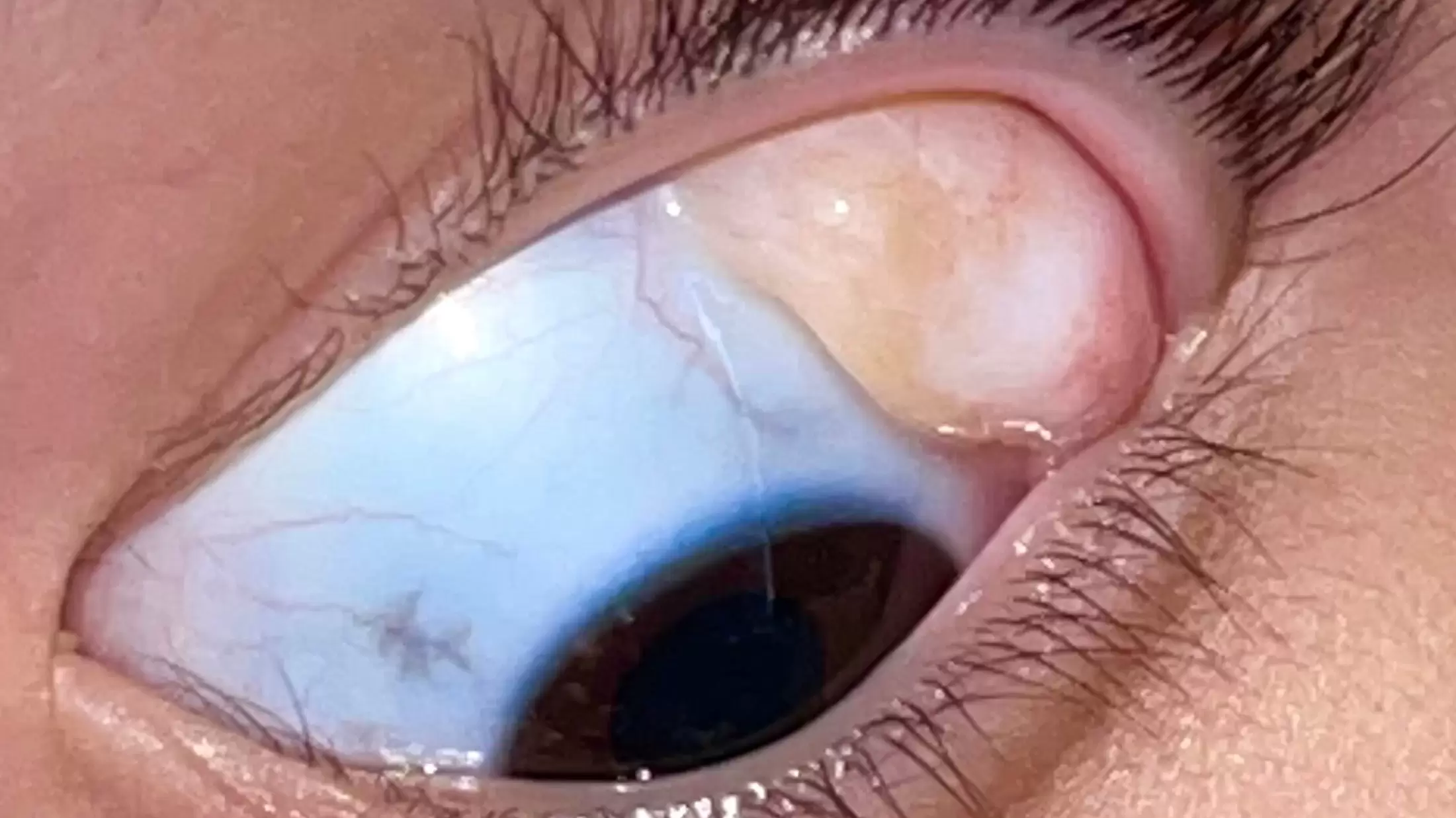 درمولیپوما چشم: هر آنچه که باید در مورد آن بدانید
